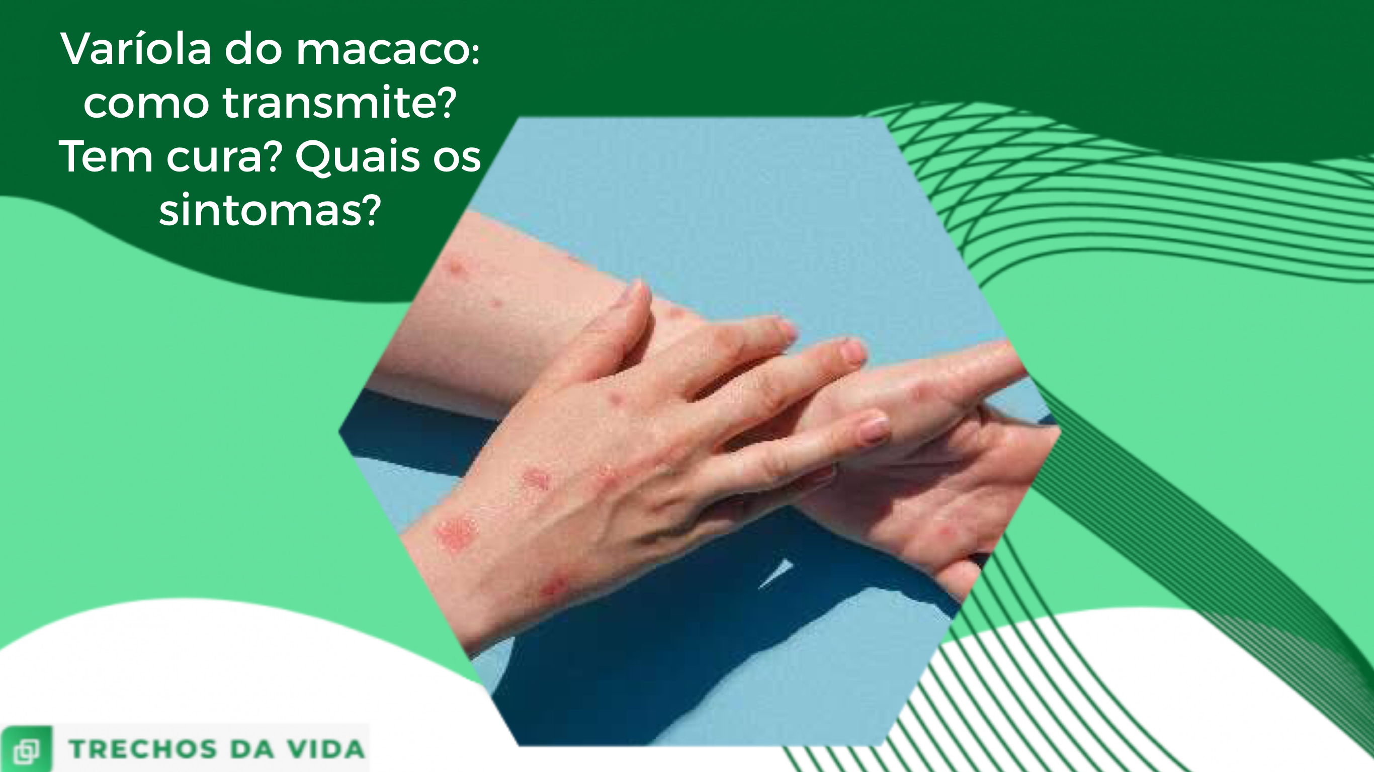 Varíola do macaco: como transmite? Tem cura? Quais os sintomas?