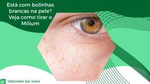 Está com bolinhas brancas na pele? Veja como tirar o Milium!