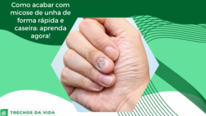 Como acabar com micose de unha de forma rápida e caseira: aprenda agora!